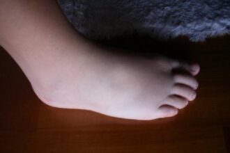 Como fazer uma dieta para tratar ou prevenir as varizes ou as tromboses venosas?