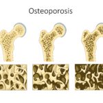 Como fazer uma dieta para prevenir ou tratar a osteoporose e proteger os ossos?